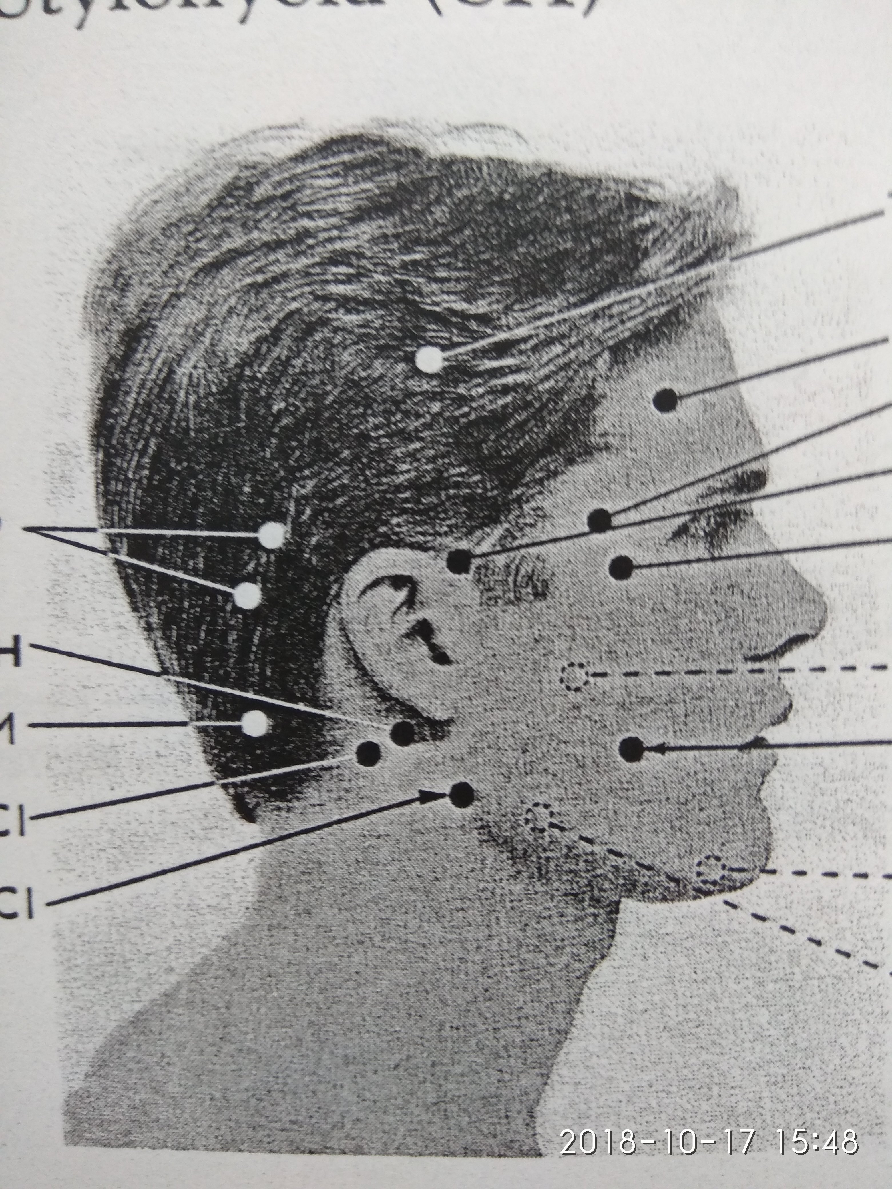 Ukázka spoušťových bodů na hlavě člověka